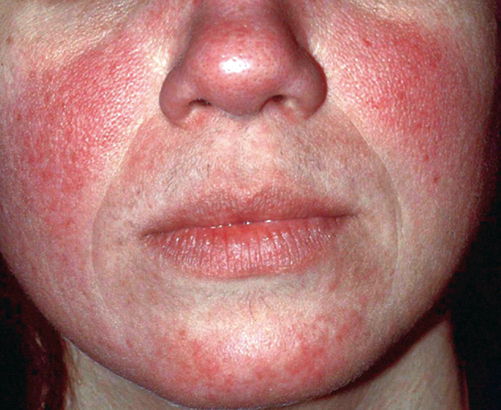 image of rosacea dermatitis